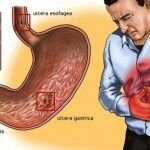 gastritis nerviosa