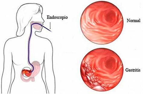 Cómo tratar la gastritis