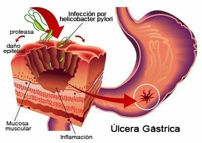 Cuál es el tratamiento para la inflamación de la mucosa gástrica